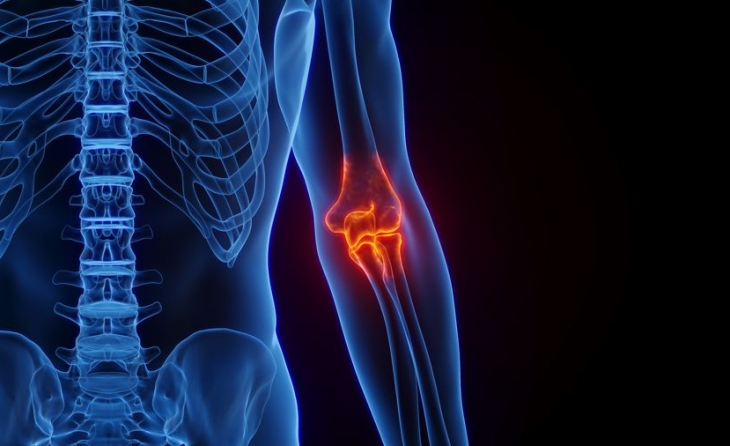 Επικονδυλίτιδα